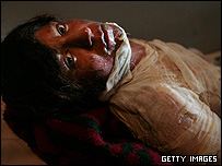 یک قربانی خودسوزی در بیمارستان هرات