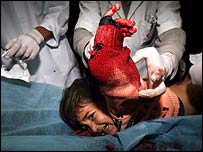  زخمی فلسطینی بچی