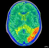 Imagem de cérebro com alzheimer