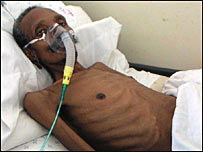 بيمار توبرکلوز