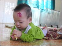 Trẻ em bị nhiễm HIV/AIDS tại Việt Nam