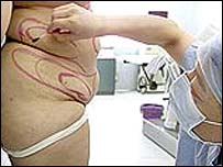 Phẫu thuật thẩm mỹ