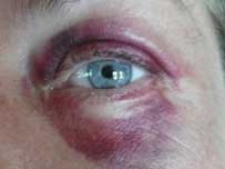black eye