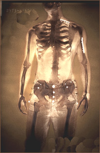 شکستگی  استخوان