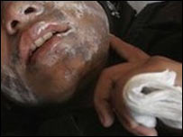 तेजाब हमले में घायल छात्रा