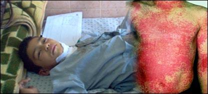 د روماتيزم په تبه اخته ماشوم