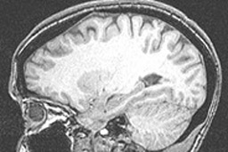 MRI Scan courtesy of R Deangelo (Creative Commons)