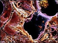 Sirozlu karaciğer hücreleri