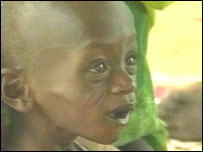 کودک نحيف سياهپوست