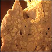 Diseased liver