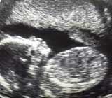 Ultrasound picture of a foetus