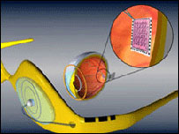 O olho biônico. Cortesia: Moorfields Eye Hospital